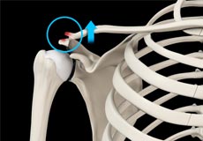 AC Joint Dislocation/Acromioclavicular Joint Dislocation