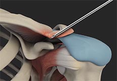 AC Joint Stabilisation