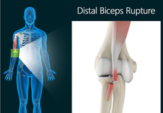 Distal Biceps Injuries