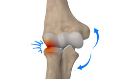 Lateral Impingement of the Elbow