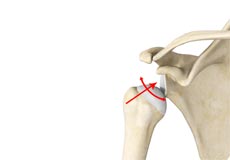 Multidirectional Instability of the Shoulder