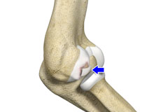 Osteochondritis Dissecans of Elbow