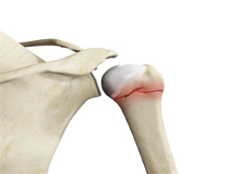 Proximal Humerus Resection and Reconstruction