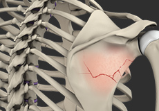 Shoulder Ligament Injuries