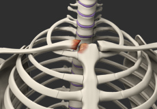 Sternoclavicular Arthritis