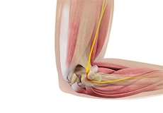 Ulnar Nerve Transposition