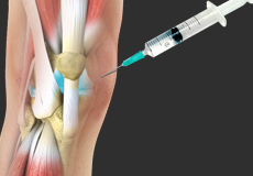 Viscosupplementation for Elbow Arthritis